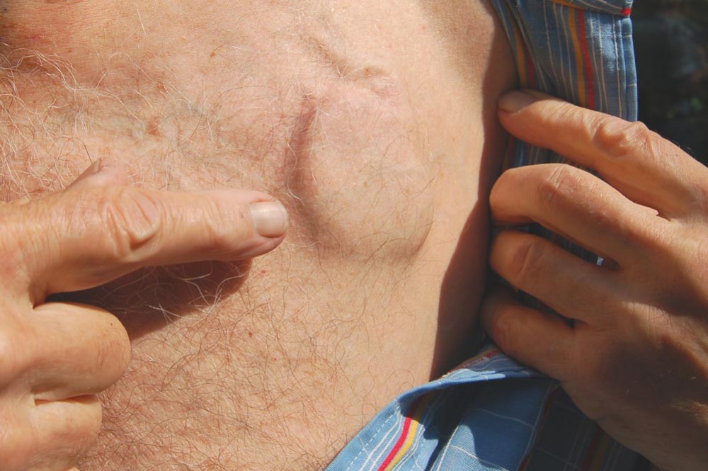 Американка получила первый Wi-Fi-кардиостимулятор - изображение обложка